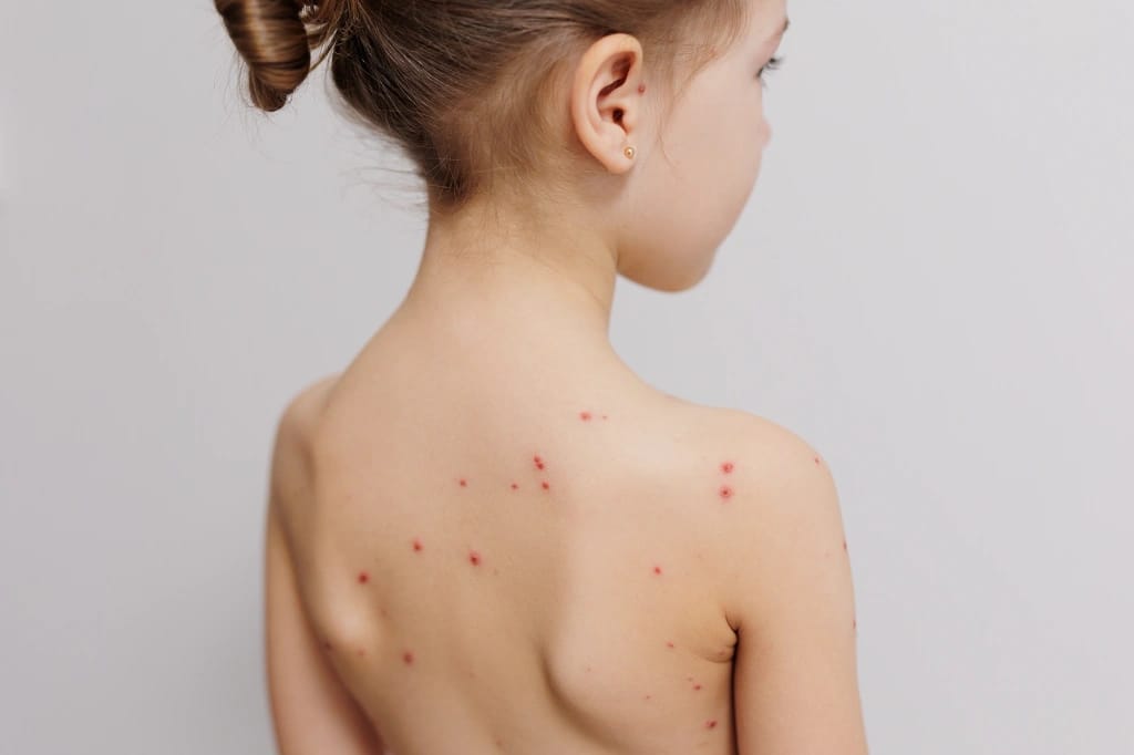 Chickenpox image