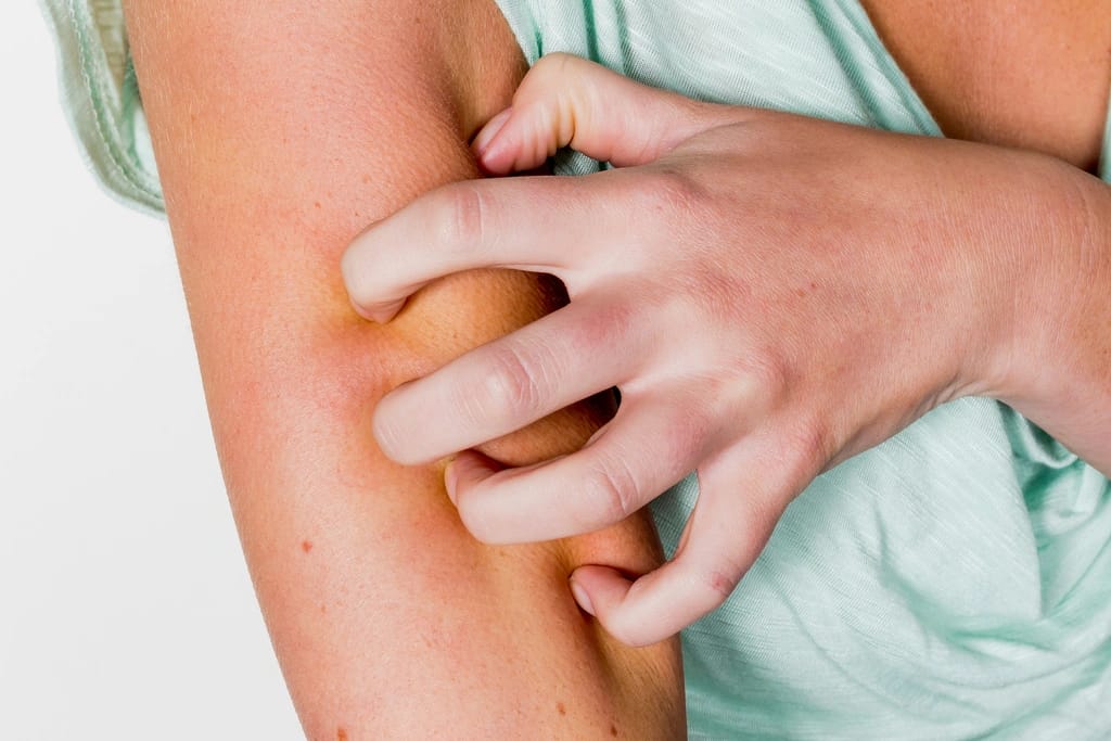 Insect Bite image