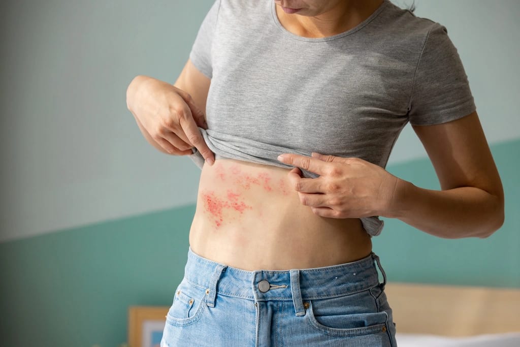 Shingles image
