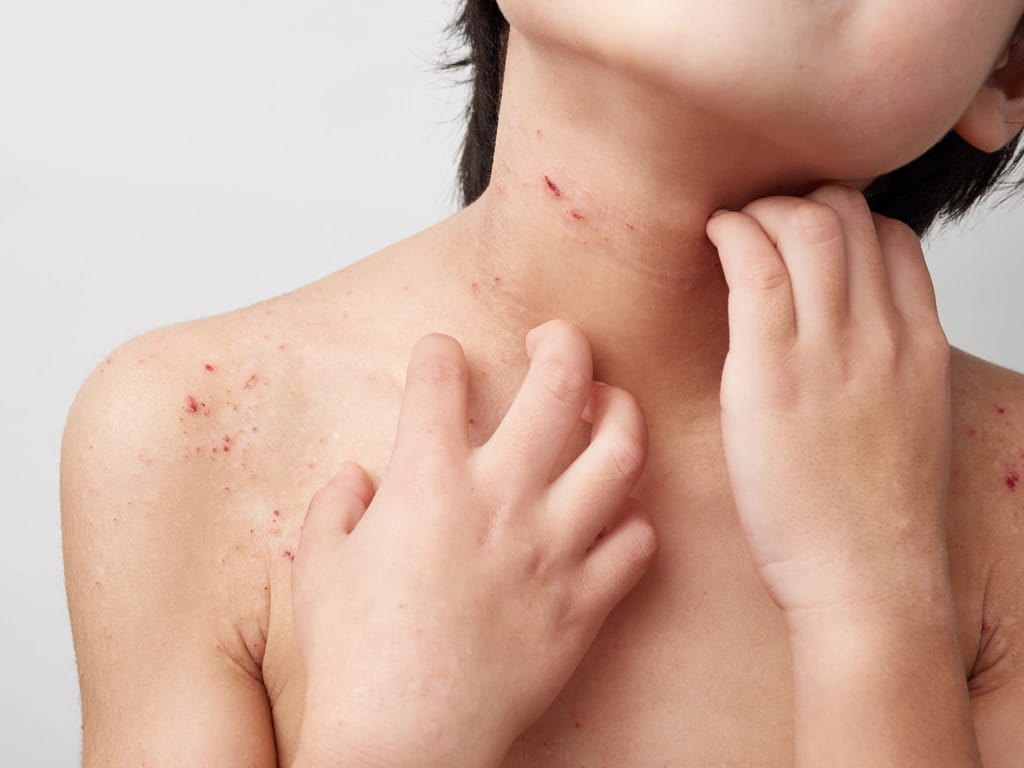 Impetigo image