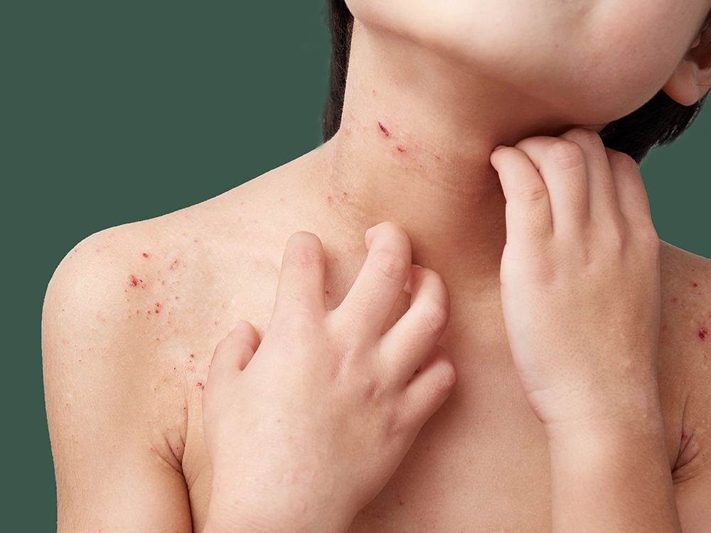 Impetigo