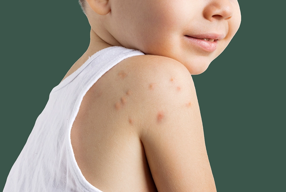 Insect Bite