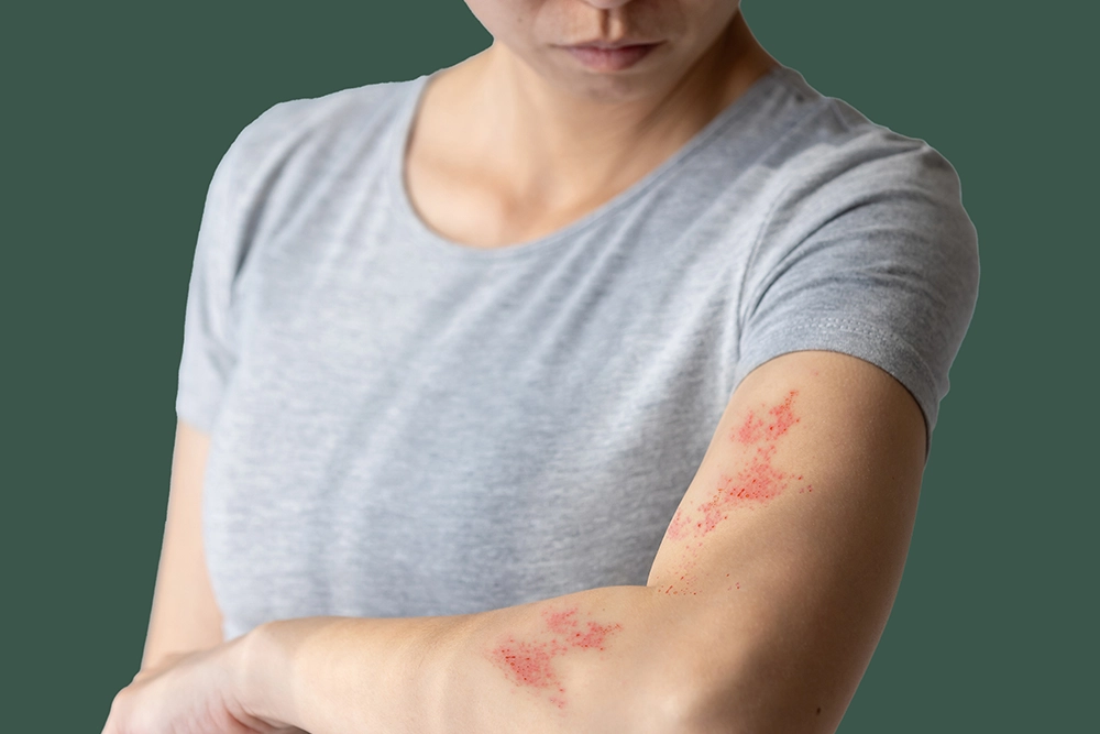 Shingles